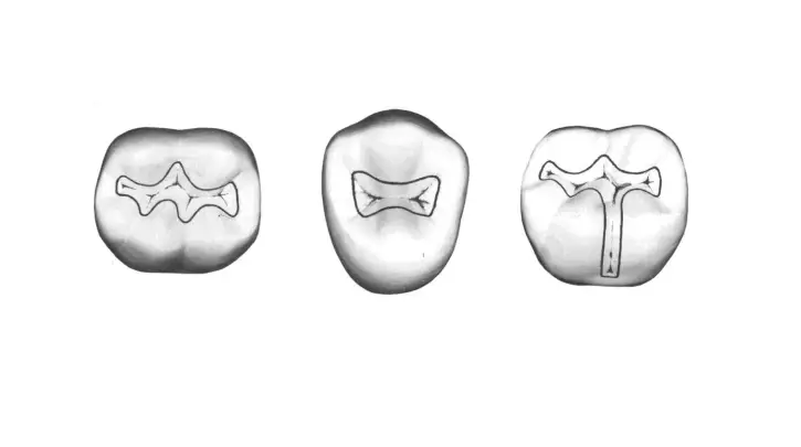 Why dentists don't drill like they used to