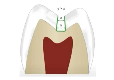 Why dentists don't drill like they used to